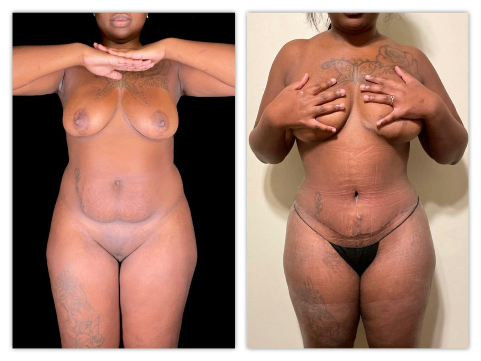 Tummy Tuck Before & After Gallery - Patient 133183825 - Image 1