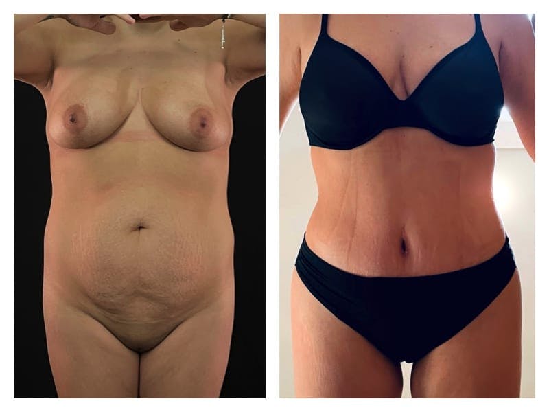 Tummy Tuck Before & After Gallery - Patient 133183826 - Image 1