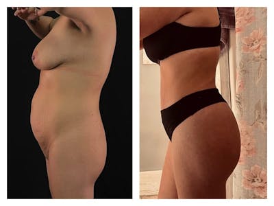 Tummy Tuck Before & After Gallery - Patient 133183826 - Image 1