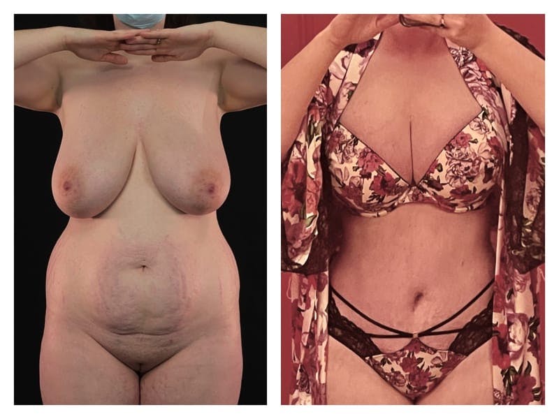 Mommy Makeover Before & After Gallery - Patient 133183839 - Image 6