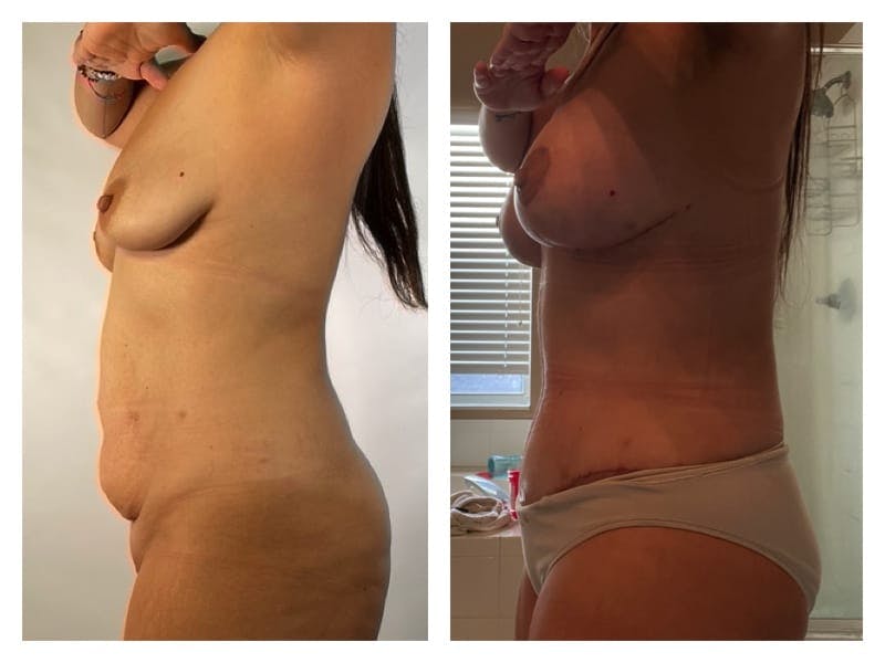 Mommy Makeover Before & After Gallery - Patient 133183854 - Image 2