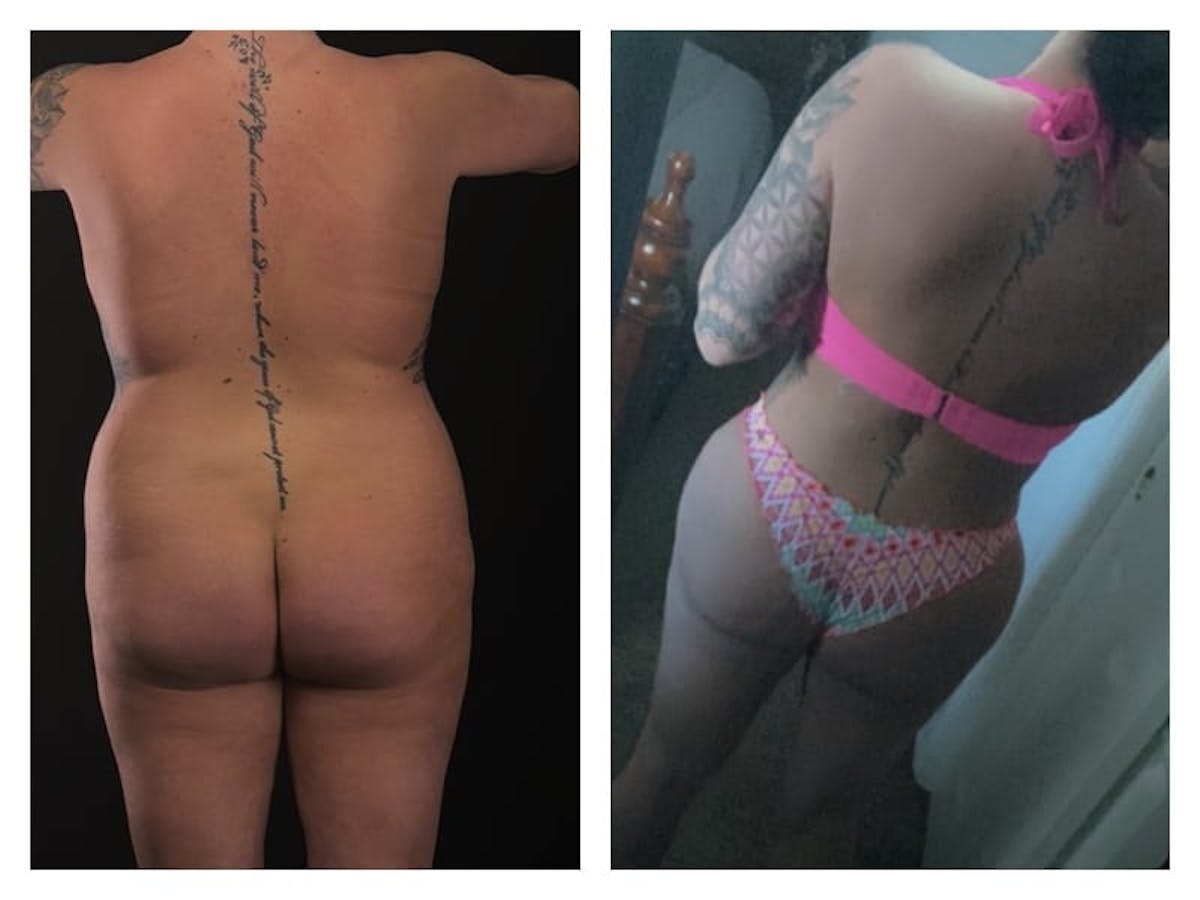 Tummy Tuck Before & After Gallery - Patient 133183855 - Image 3