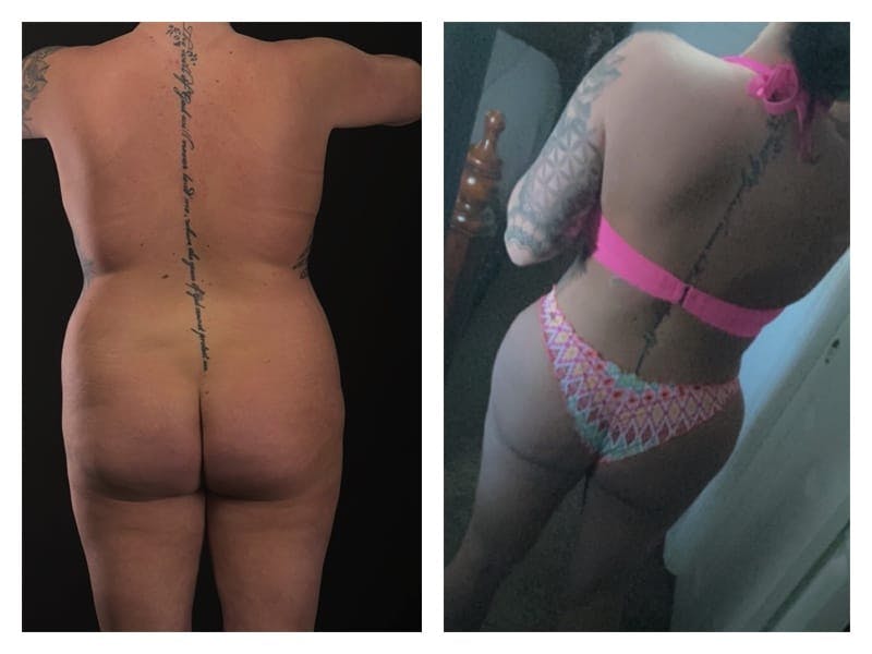 Tummy Tuck Before & After Gallery - Patient 133183855 - Image 2