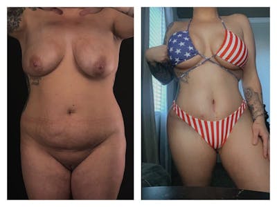 Tummy Tuck Before & After Gallery - Patient 133183855 - Image 1