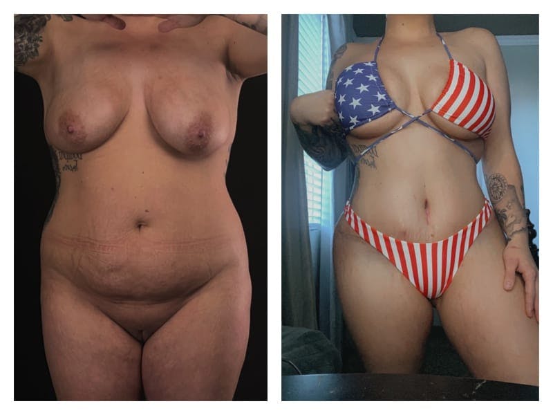Tummy Tuck Before & After Gallery - Patient 133183855 - Image 1