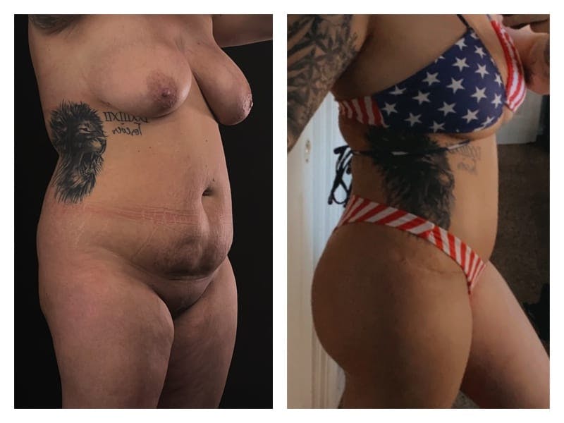 Tummy Tuck Before & After Gallery - Patient 133183855 - Image 3