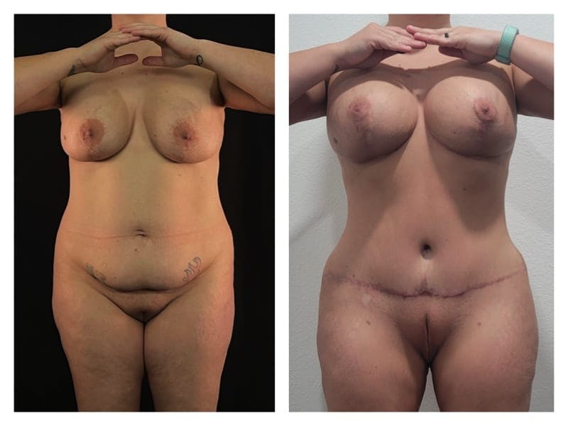 Mommy Makeover Before & After Gallery - Patient 133183862 - Image 1
