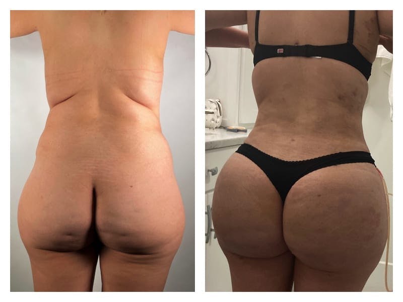 Tummy Tuck Before & After Gallery - Patient 133183870 - Image 2