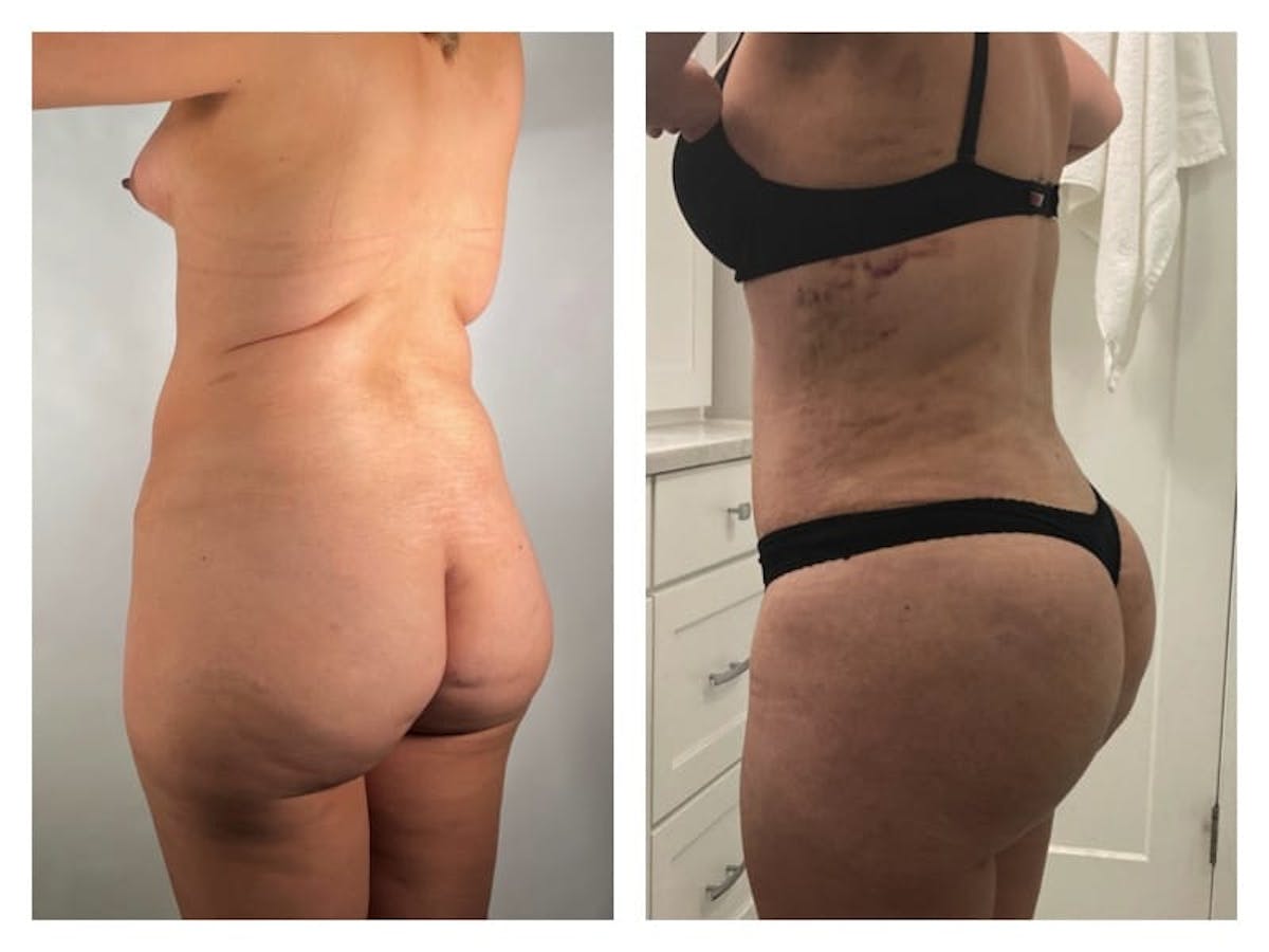 Brazilian Butt Lift Before & After Gallery - Patient 133183869 - Image 2