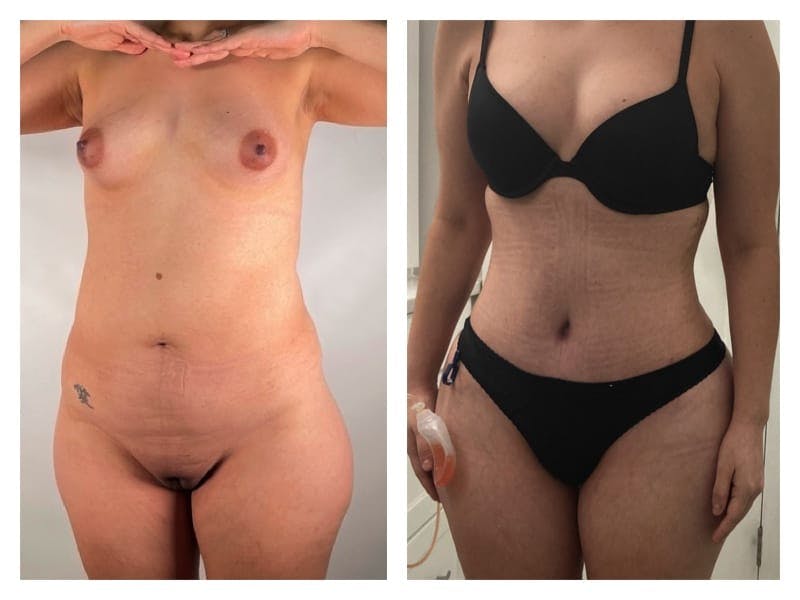 Brazilian Butt Lift Before & After Gallery - Patient 133183869 - Image 4