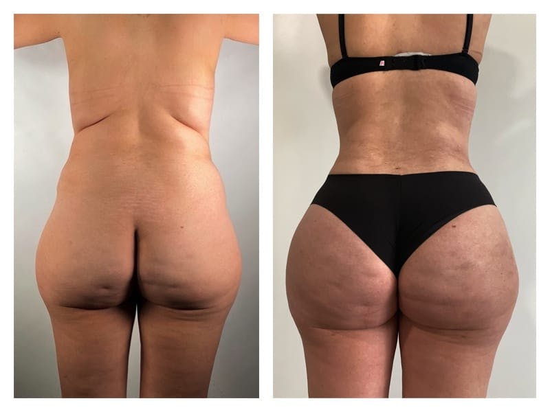 Brazilian Butt Lift Before & After Gallery - Patient 133183872 - Image 1