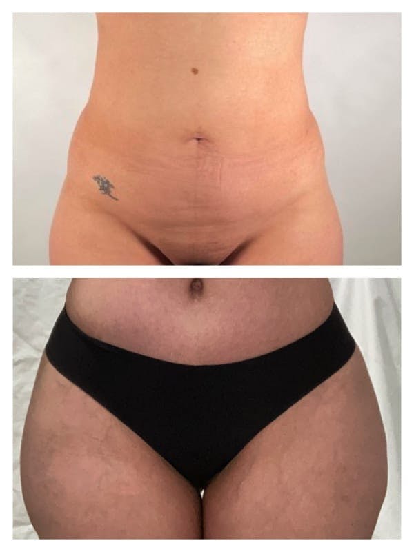Brazilian Butt Lift Before & After Gallery - Patient 133183872 - Image 2