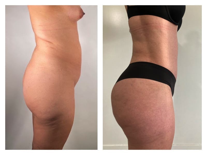 Brazilian Butt Lift Before & After Gallery - Patient 133183872 - Image 4