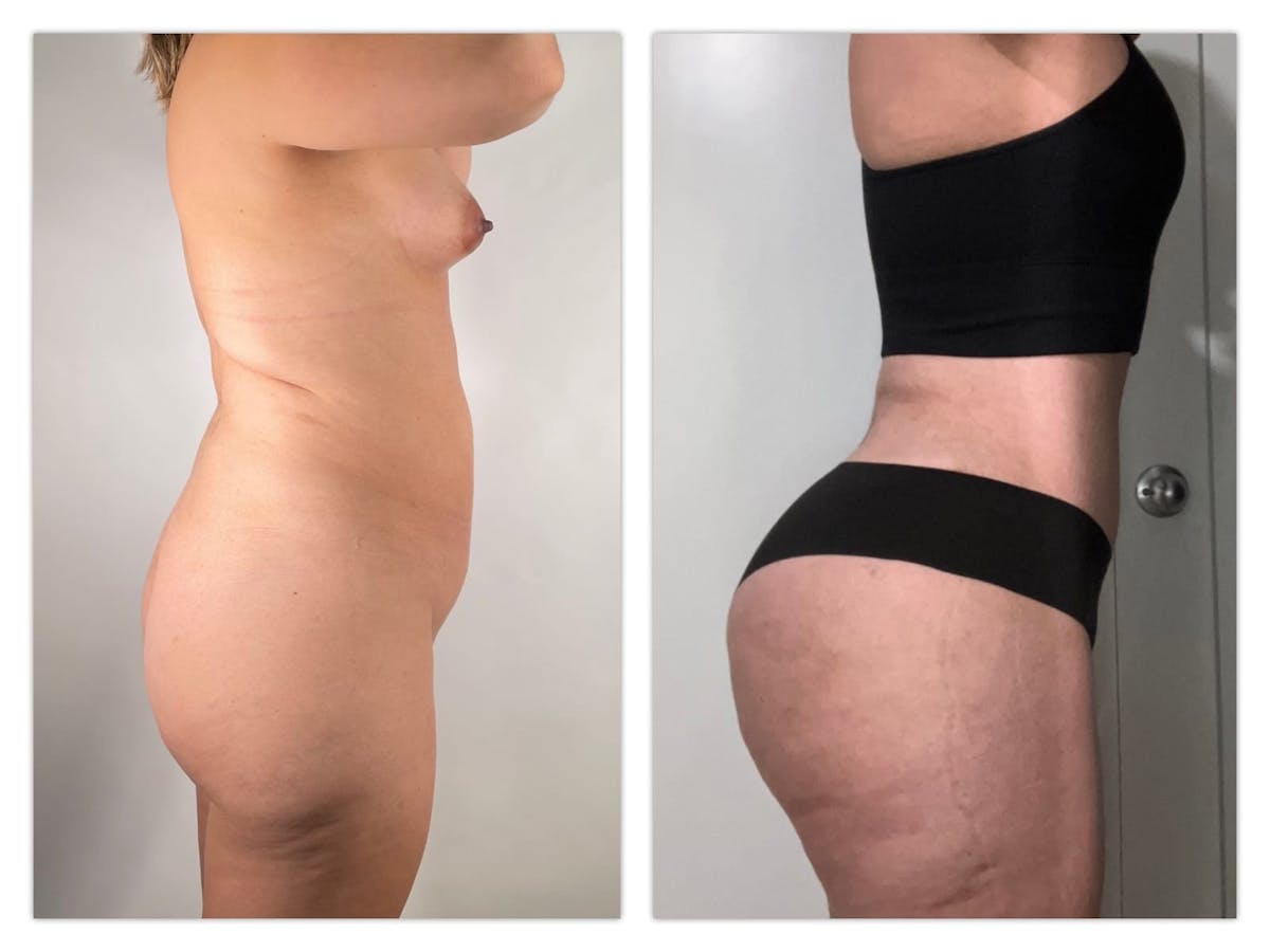 Tummy Tuck Before & After Gallery - Patient 133183875 - Image 2
