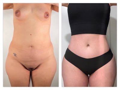 Tummy Tuck Before & After Gallery - Patient 133183875 - Image 1