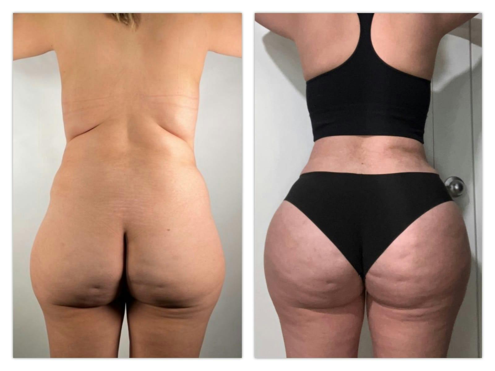 Brazilian Butt Lift Before & After Gallery - Patient 133183874 - Image 1