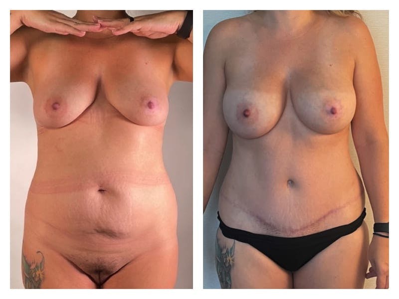 Tummy Tuck Before & After Gallery - Patient 133183888 - Image 1