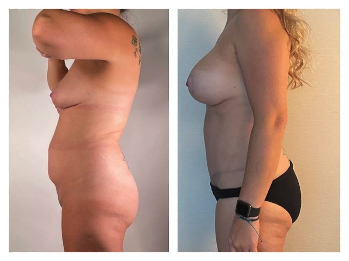 Tummy Tuck Before & After Gallery - Patient 133183888 - Image 3