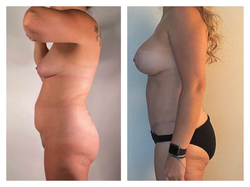 Tummy Tuck Before & After Gallery - Patient 133183888 - Image 2