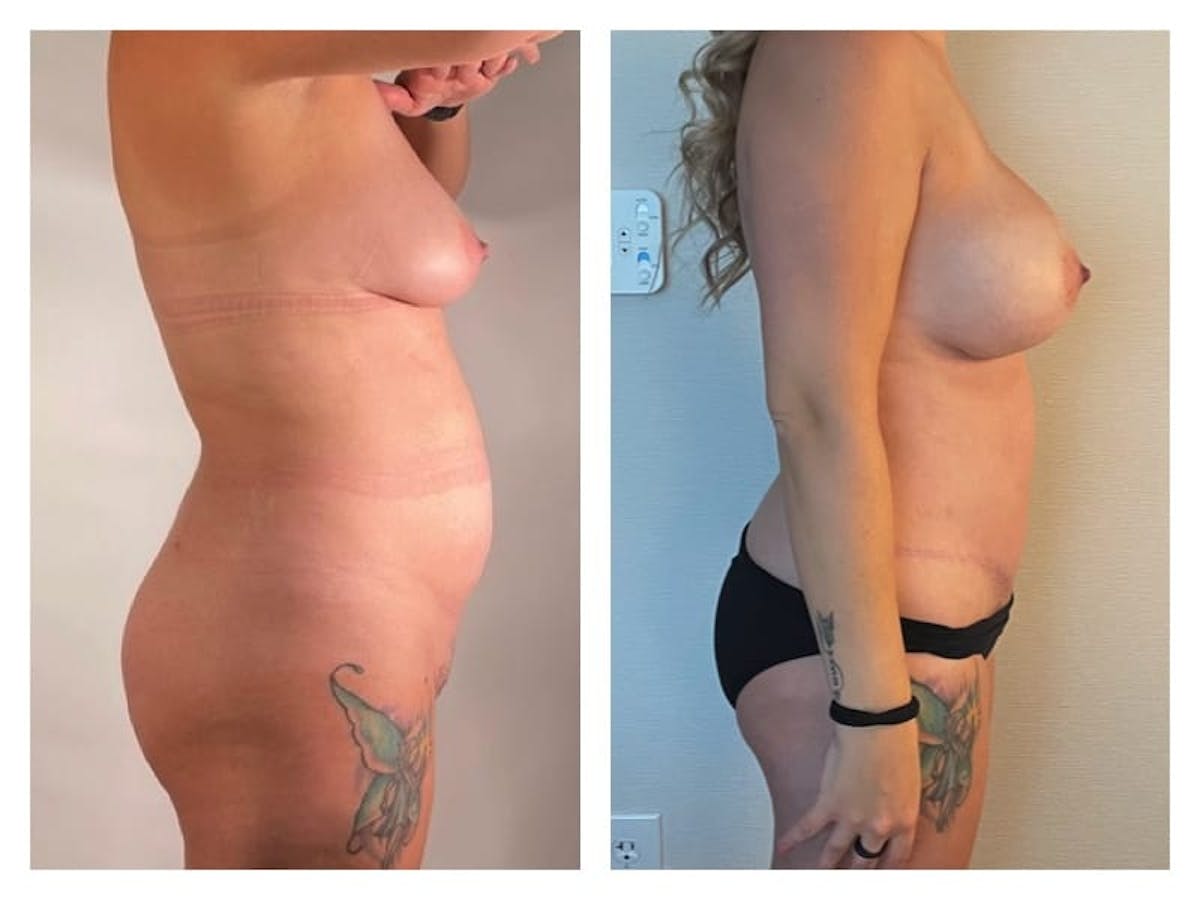 Tummy Tuck Before & After Gallery - Patient 133183888 - Image 4