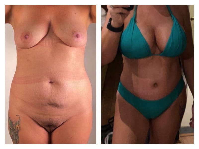 Tummy Tuck Before & After Gallery - Patient 133183888 - Image 4