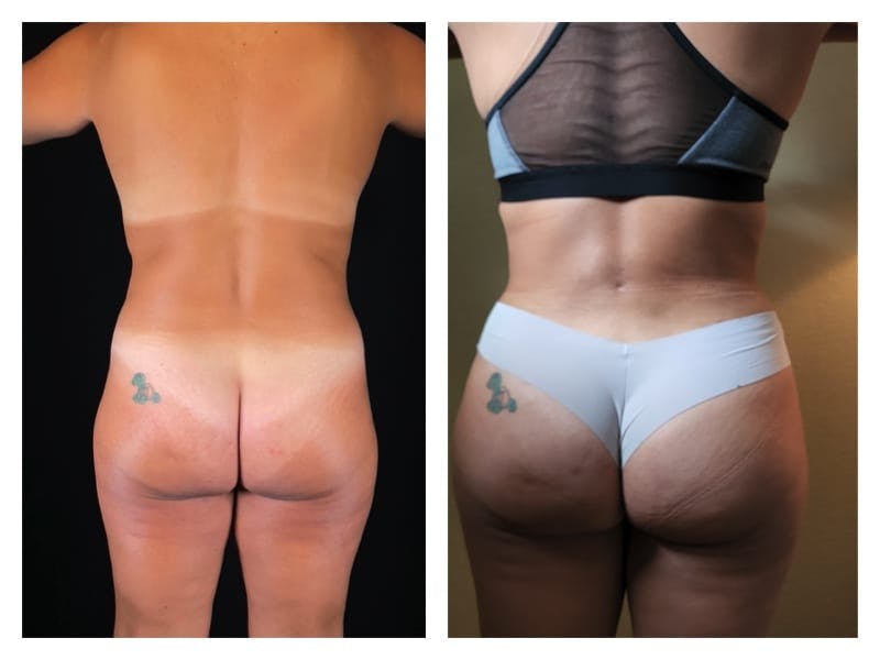 Tummy Tuck Before & After Gallery - Patient 133183889 - Image 2
