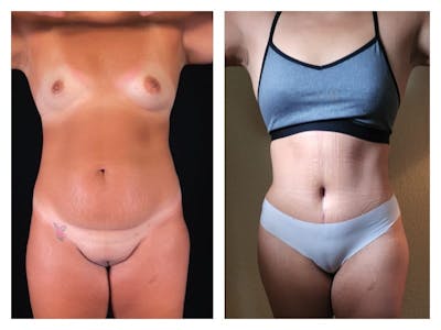 Tummy Tuck Before & After Gallery - Patient 133183889 - Image 1