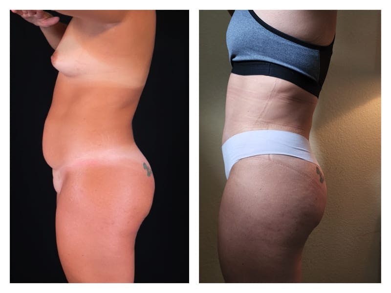 Tummy Tuck Before & After Gallery - Patient 133183889 - Image 3