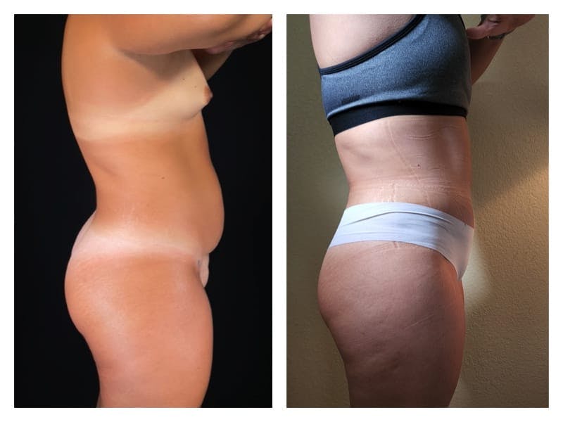 Tummy Tuck Before & After Gallery - Patient 133183889 - Image 4