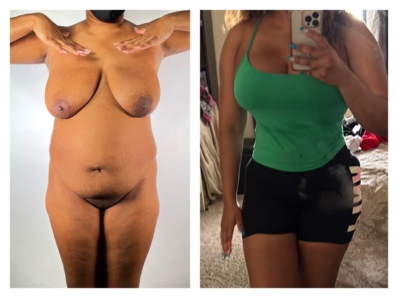 Mommy Makeover Before & After Gallery - Patient 133183901 - Image 1