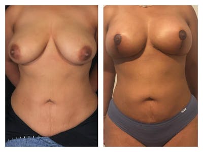Breast Augmentation Before & After Gallery - Patient 133183912 - Image 1