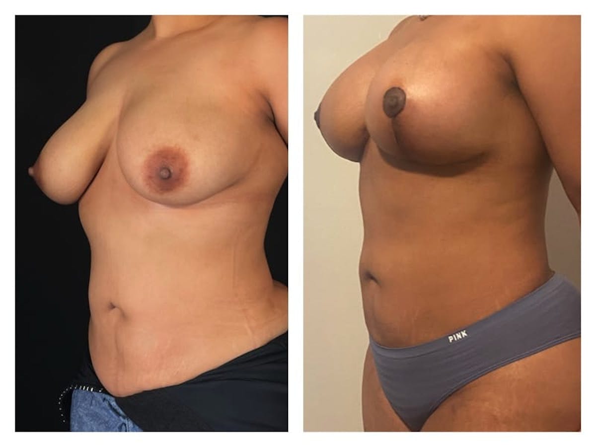 Breast Augmentation Before & After Gallery - Patient 133183912 - Image 2