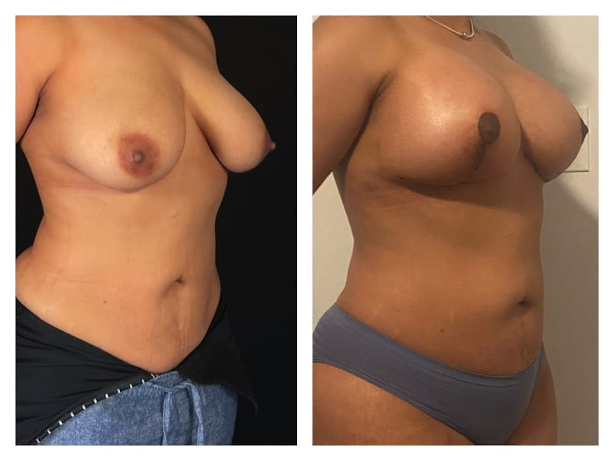 Breast Augmentation Before & After Gallery - Patient 133183912 - Image 3