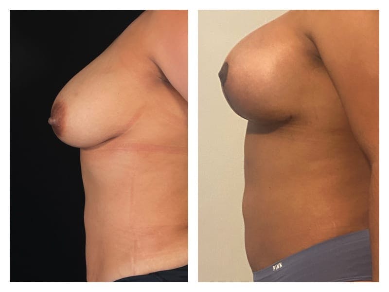 Breast Augmentation Before & After Gallery - Patient 133183912 - Image 4