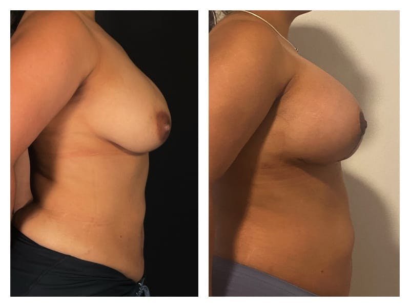 Breast Augmentation Before & After Gallery - Patient 133183912 - Image 5