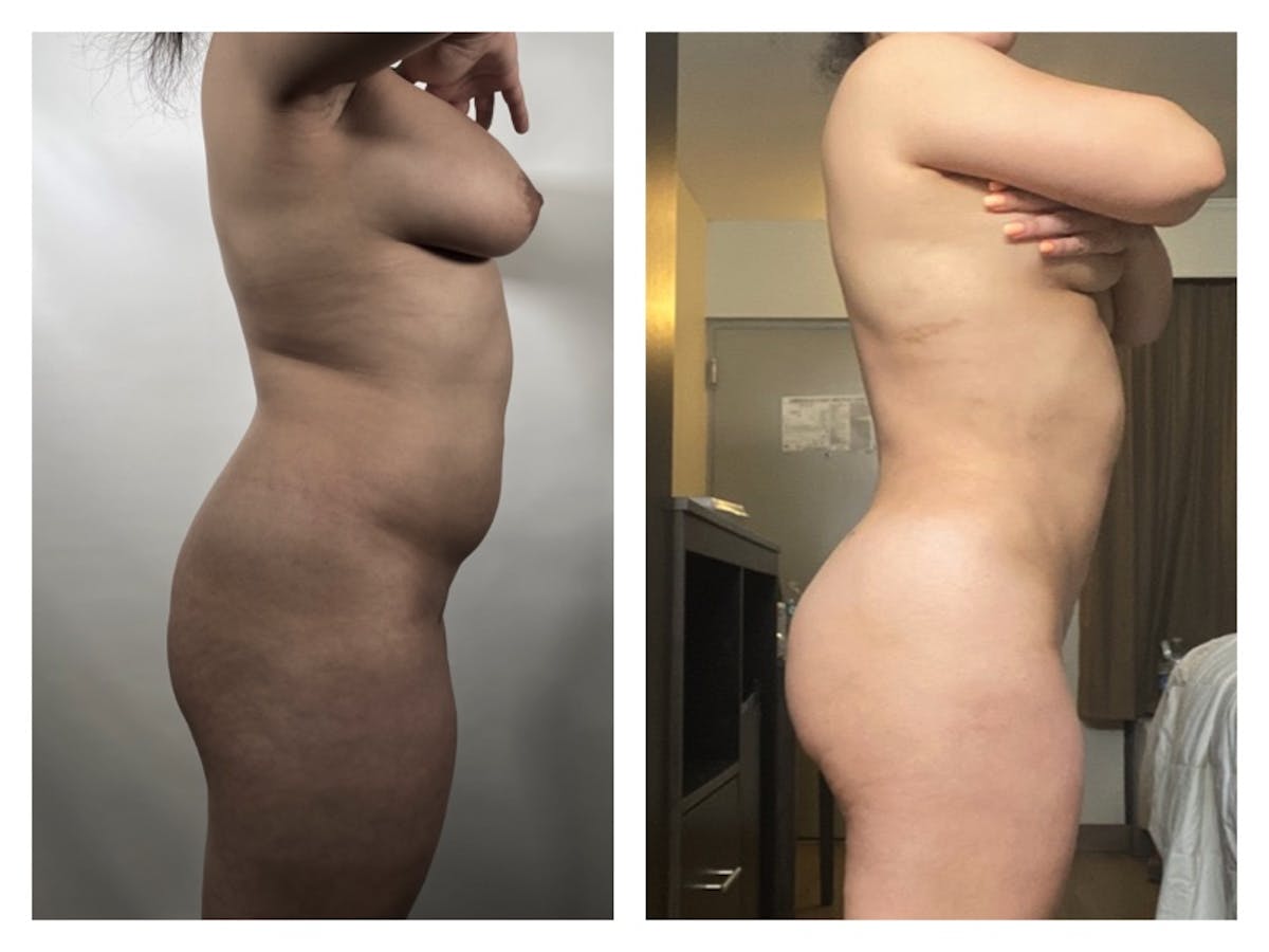 Brazilian Butt Lift Before & After Gallery - Patient 175515029 - Image 1