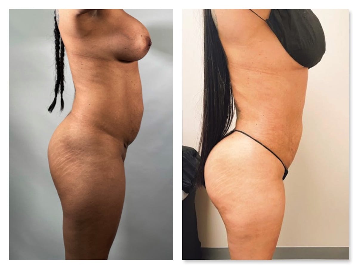 Brazilian Butt Lift Before & After Gallery - Patient 175515028 - Image 1