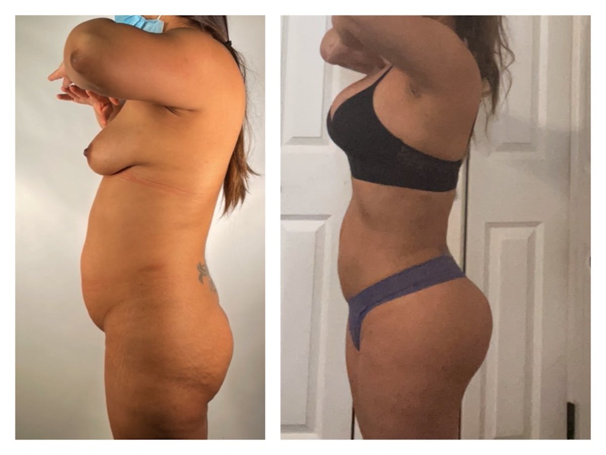 Brazilian Butt Lift Before & After Gallery - Patient 175515025 - Image 1