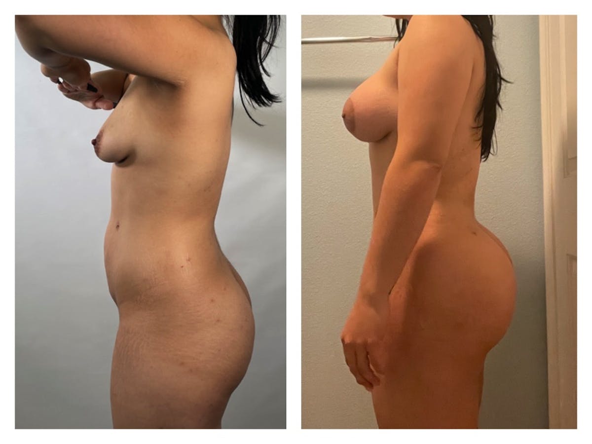 Brazilian Butt Lift Before & After Gallery - Patient 175515022 - Image 1