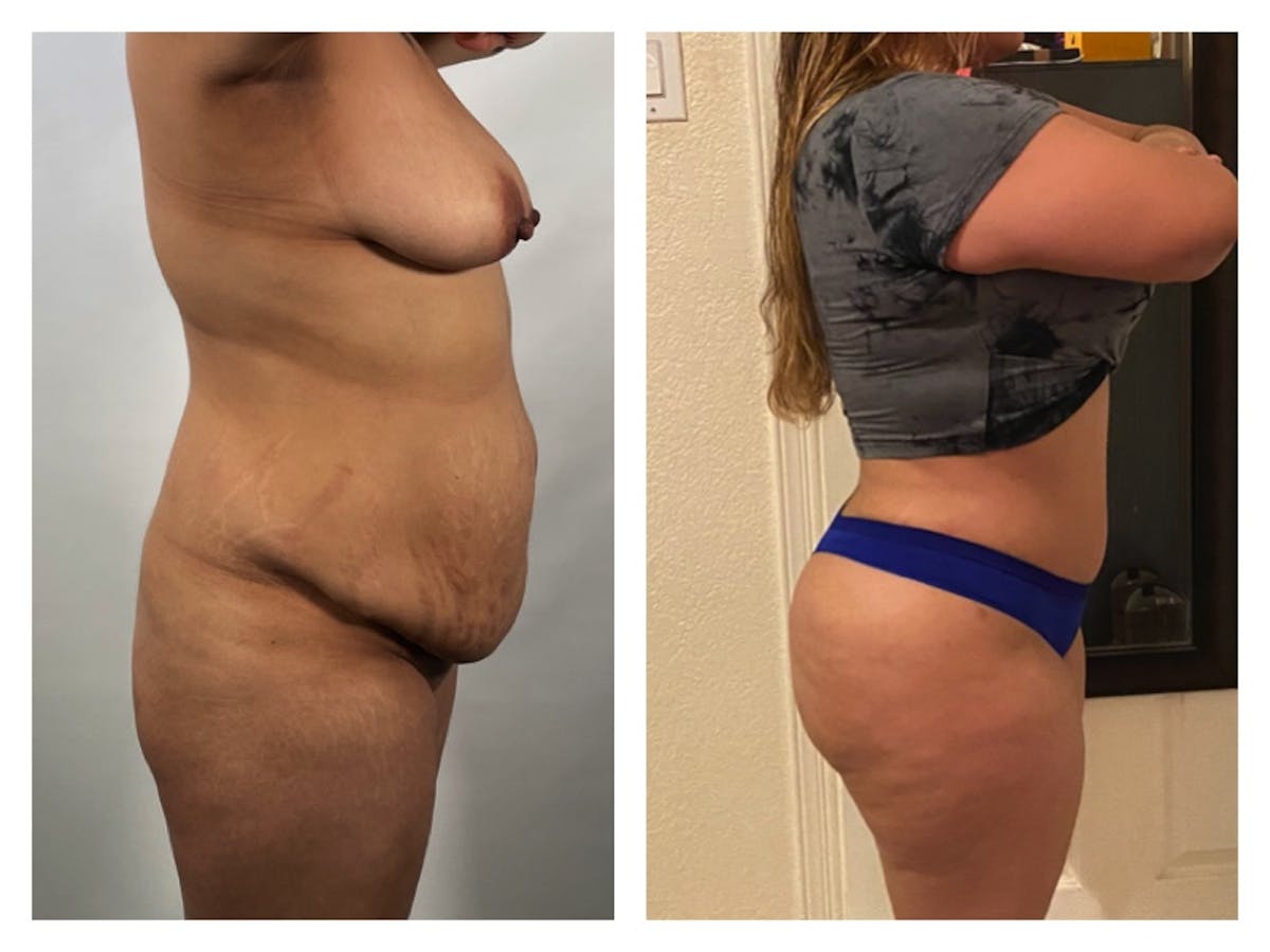 Brazilian Butt Lift Before & After Gallery - Patient 175515020 - Image 1