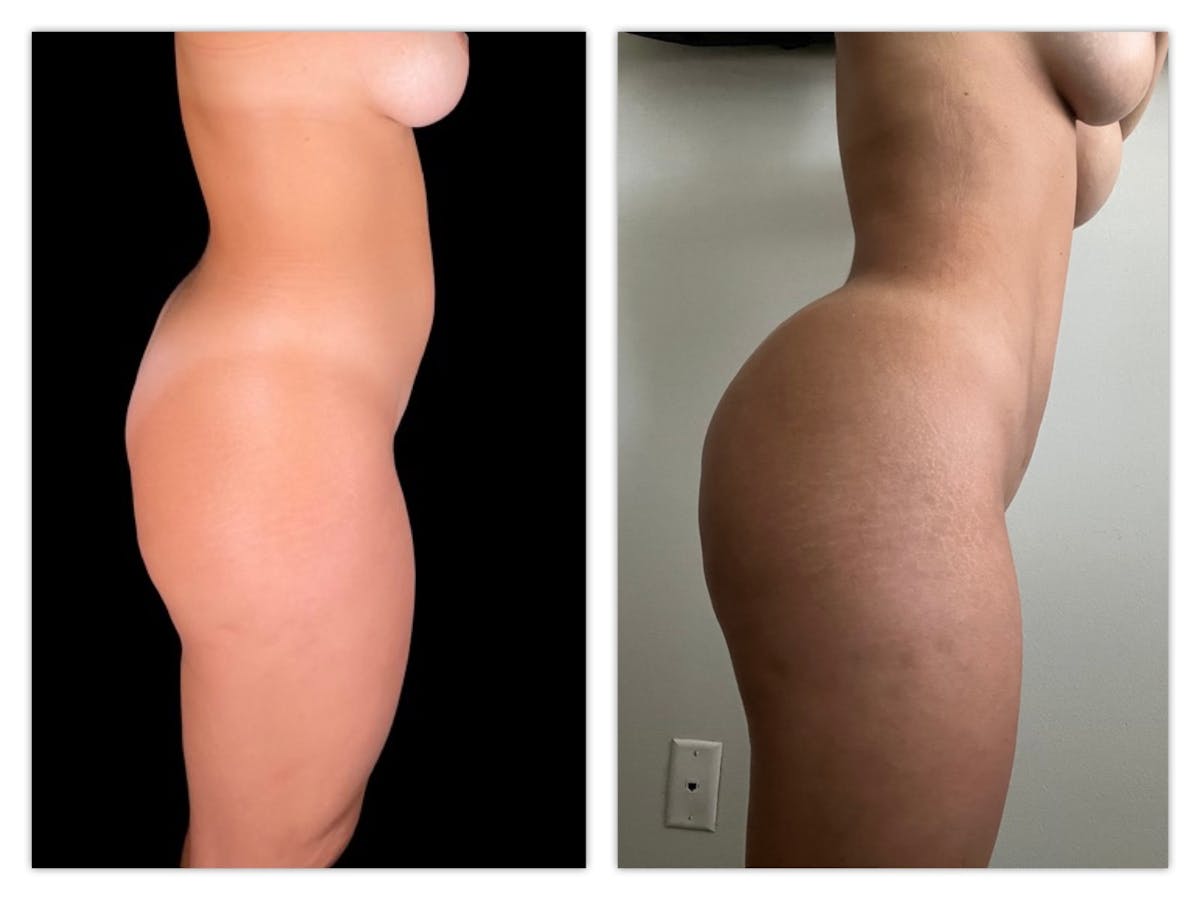 Brazilian Butt Lift Before & After Gallery - Patient 175515019 - Image 2