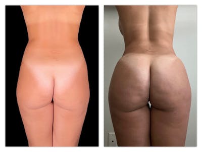 Brazilian Butt Lift Before & After Gallery - Patient 175515019 - Image 1
