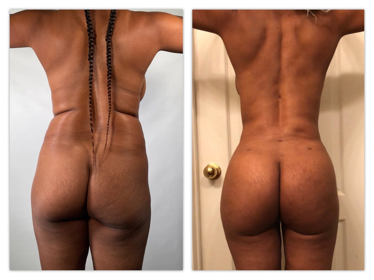 Brazilian Butt Lift Before & After Gallery - Patient 175515018 - Image 1
