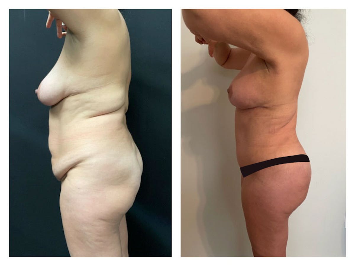 Brazilian Butt Lift Before & After Gallery - Patient 175515017 - Image 1