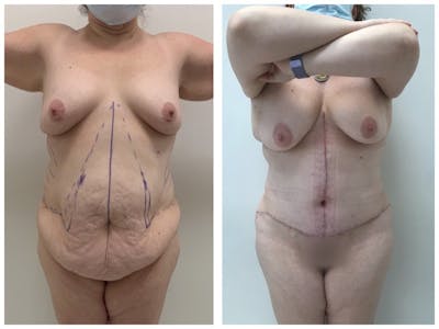 Liposuction Before & After Gallery - Patient 175515133 - Image 1