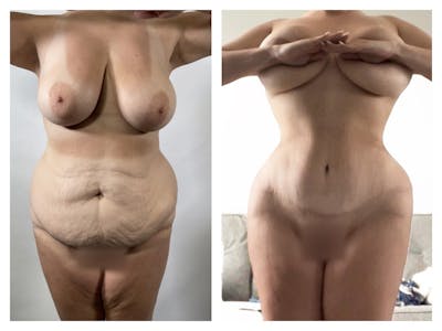 Liposuction Before & After Gallery - Patient 175515132 - Image 1