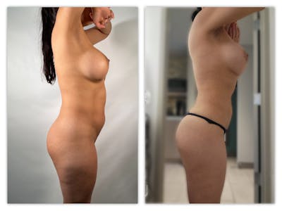 Liposuction Before & After Gallery - Patient 175515131 - Image 1