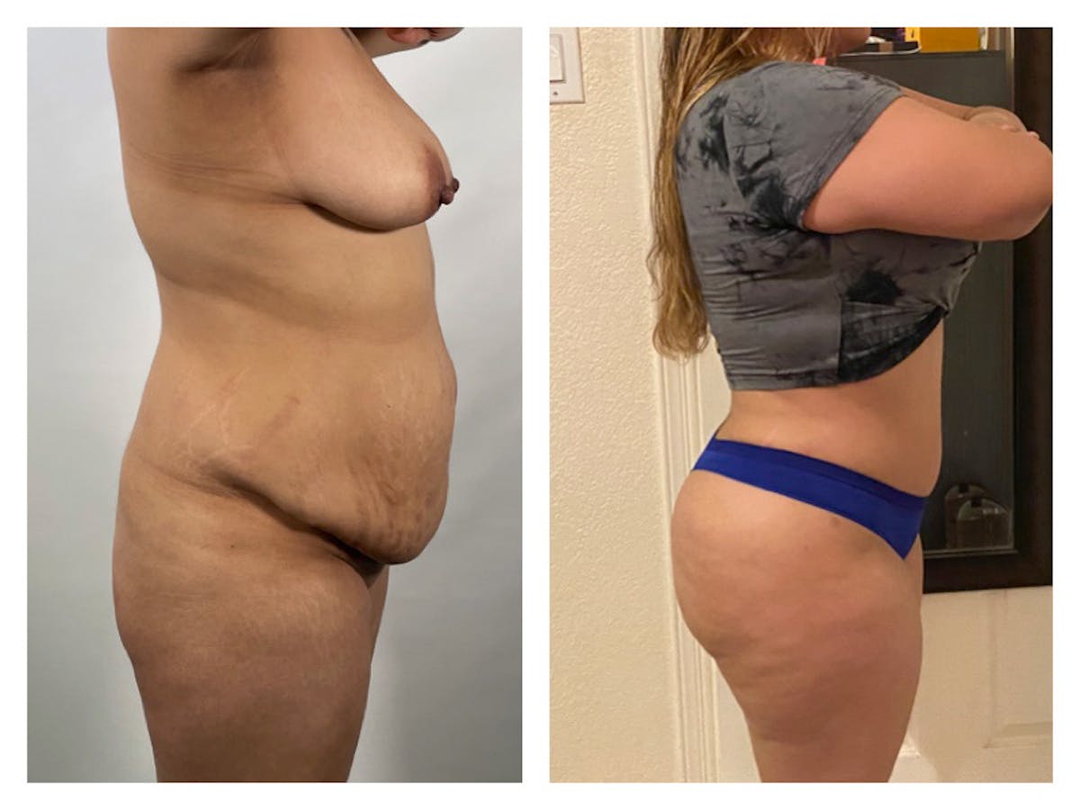Liposuction Before & After Gallery - Patient 175515130 - Image 1