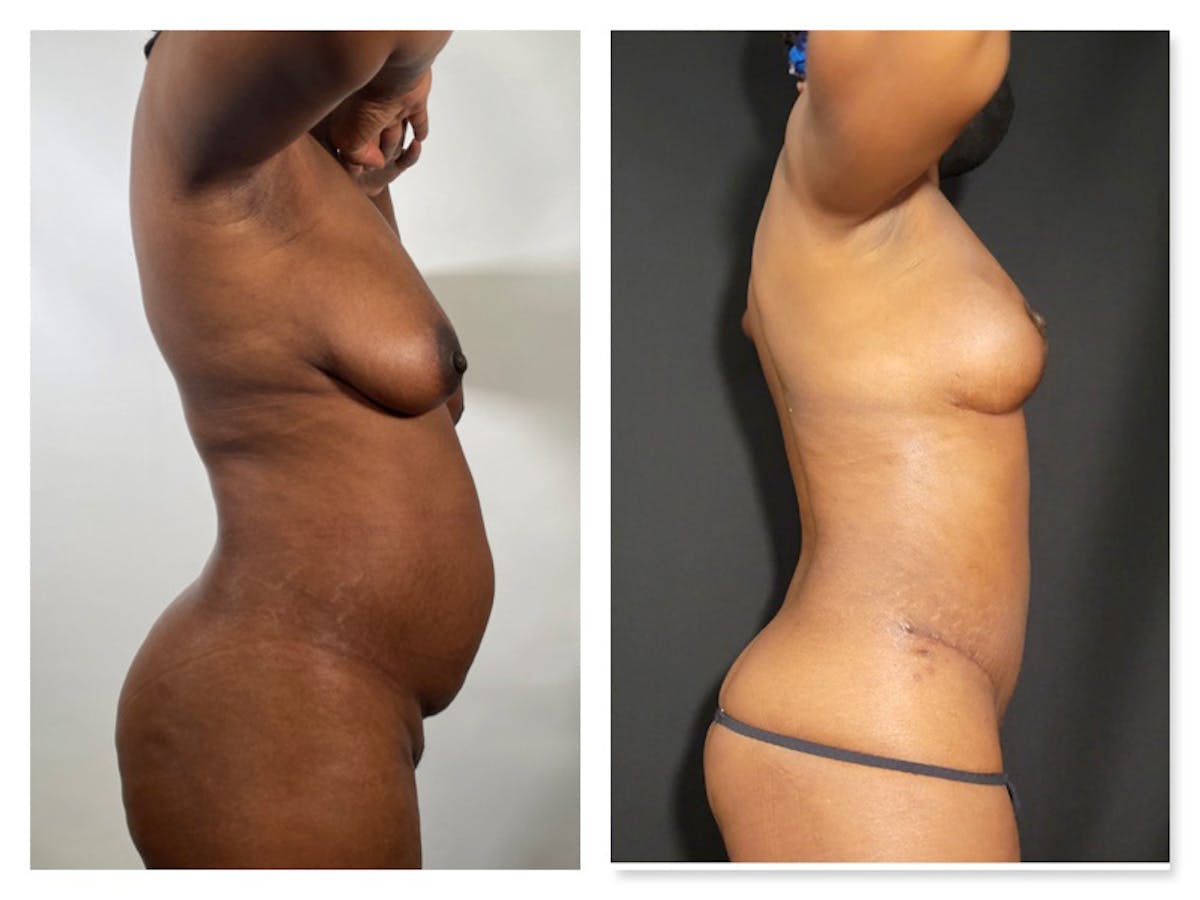 Liposuction Before & After Gallery - Patient 175515128 - Image 1