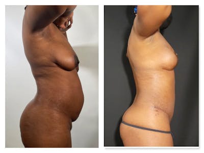 Liposuction Before & After Gallery - Patient 175515128 - Image 1
